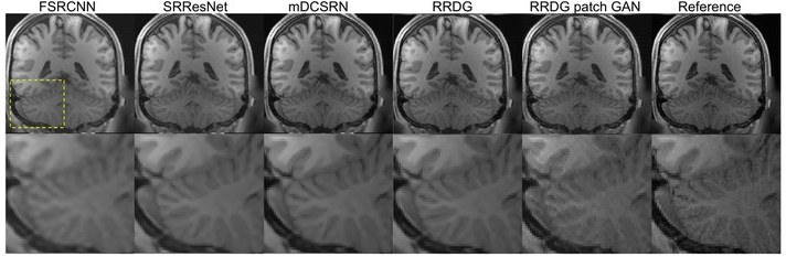 Axial brain-MRI super-resolution across FSRCNN, SRResNet, mDCSRN, RRDB and the RRDB patch-GAN, beside the ground-truth reference.